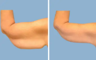 Before and After